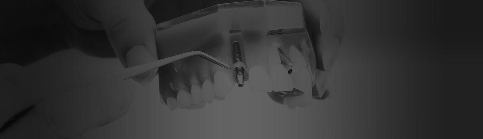 Dental Implants